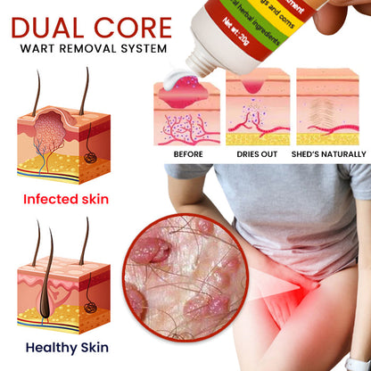 19 Pieces LEFT!!.. Cvreoz® FemGenital Wart Remover Cream ✅ 70% Off! Ends in 10 Minutes!