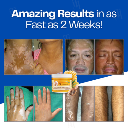 21 Pieces LEFT!!.. Cvreoz® VitiClear Bee Venom Cream