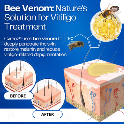 21 Pieces LEFT!!.. Cvreoz® VitiClear Bee Venom Cream